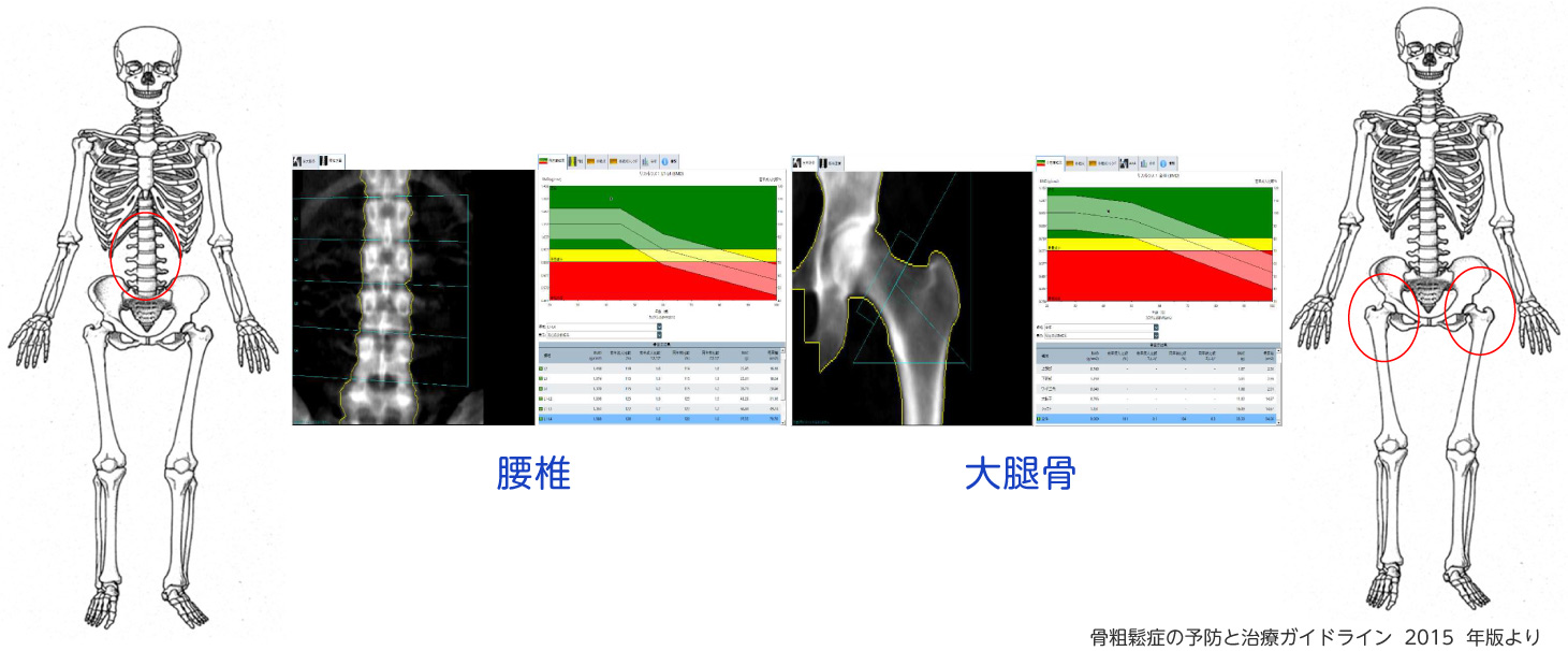 腰椎・大腿骨